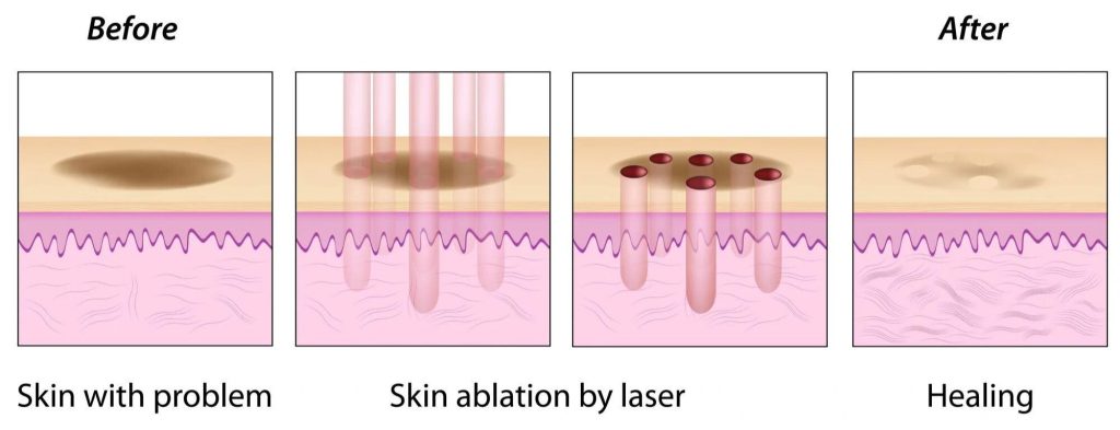 Treat Acne Scars with Fractional CO2 Laser