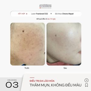 Showcase lam sang laser fractional CO2 ket hop voi Chrono Repair