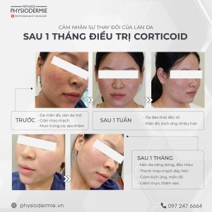 Su cai thien cua lan da nhiem Corticoid sau 1 thang dieu tri theo phac do cua Methode Physiodermie