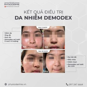 ket qua sau 50 ngay dieu tri lan da bi ung do noi mun nuoc li ti do viem da demodex