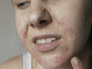 Lan da san sui noi man do keo dai neu khong dieu tri viem da demodex kip thoi