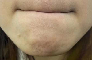 Soi ba nhon thuong xuat hien o vung cam noi tuyen ba nhon hoat dong manh