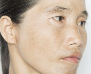 Su dung Retinol khong dung cach rat de gay sam da