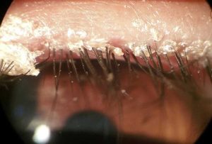 Tai sao phai tri viem da Demodex