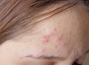 Viem da do Demodex xuat hien do da ngua ngay