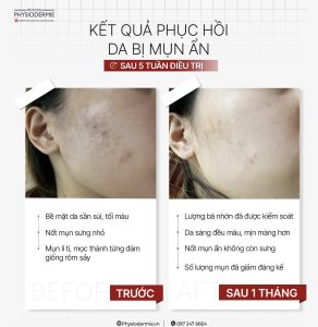 Ket-qua-cua-case-lam-sang-dieu-tri-mun-an-thanh-cong-sau-1-thang