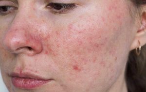 Da nao khong nen dung Retinol