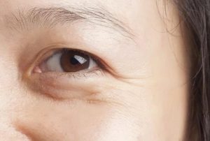 Lan da lao hoa xuat hien vet chan chim nen dung Retinol