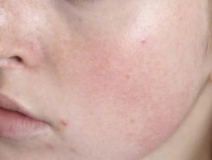 Truong hop da nao khong nen dung Retinol