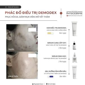 Case 2 sau 60 ngay chien dau voi Demodex lan da da giam trieu chung