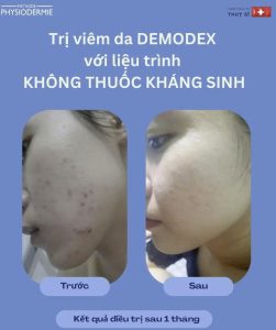 Case 3 khach hang ngung dung khang sinh va da dieu tri khoi tinh trang da viem Demodex