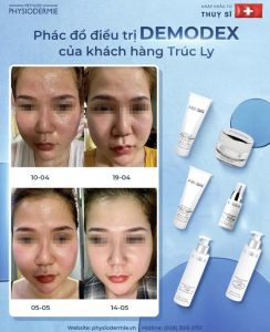 Case 4 khach hang cham dut tinh trang song chung voi Demodex
