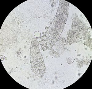 Ky sinh trung Demodex tren da mat duoi kinh hien vi