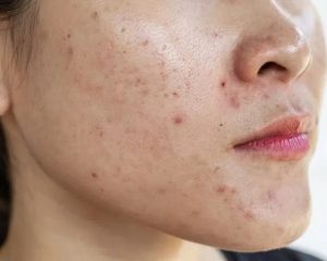 Lan da dau rat de bi bit tac lo chan long gay mun viem mun an