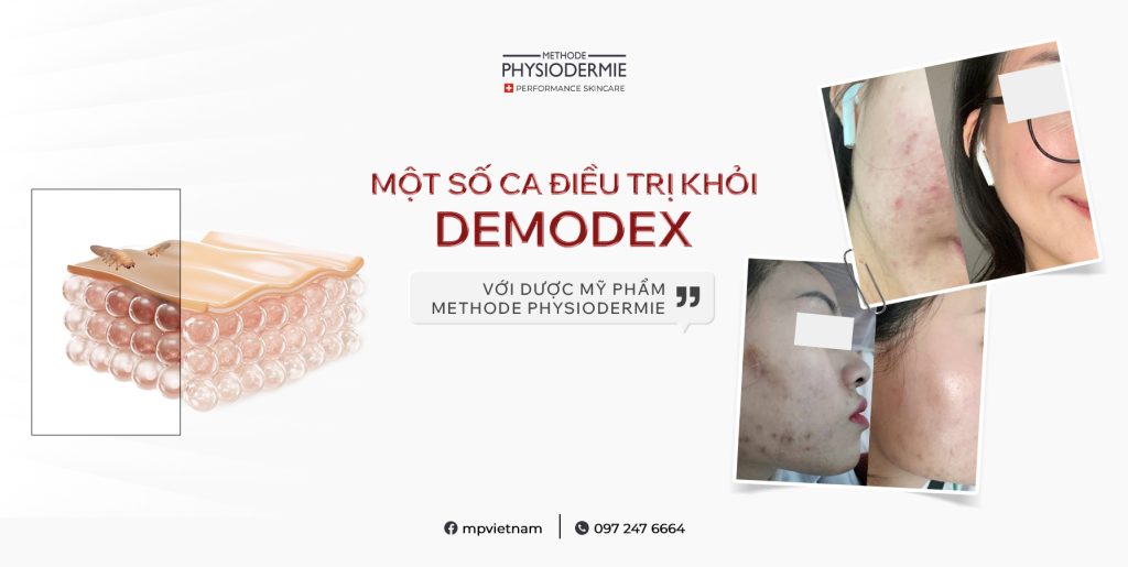 SEO Mot so ca dieu tri demodex 2410