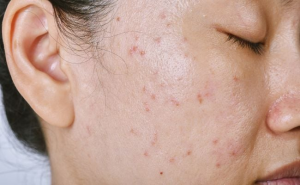 Cach ket hop Retinyl Retinoate va BHA giup kiem soat ba nhon mo mun tham