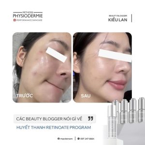 Dung Huyet thanh Retinoate Program Lan da cua Beauty Blogger Kieu Lan tre hon tuoi that den 3 tuoi