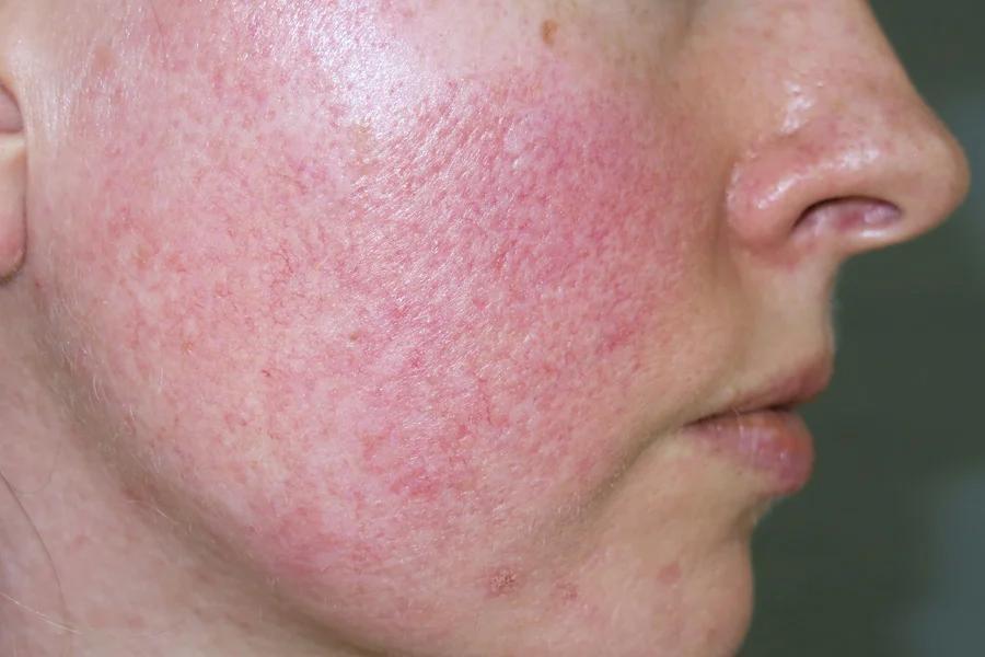 16946cf49a1030de004683fcfe4738a51758301227 da-lo-mao-mach-khi-dung-my-pham-chua-corticoid