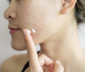 Co che hoat dong cua hoat chat Adapalene giup ngan ngua qua trinh hinh thanh mun trung ca