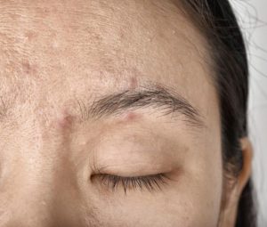 Dong ho nha Retinoid deu co kha nang kiem soat ba nhon dieu tri mun tuy vao muc do nhe hay trung binh