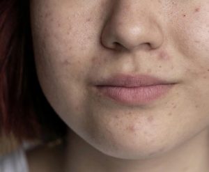 Huyet thanh Retinoate Program giup day nhanh qua trinh phuc hoi lan da sau dieu tri mun