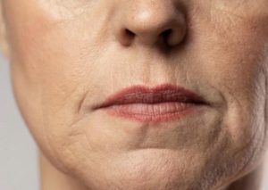 Huyet thanh Retinoate Program lam mo nep nhan cai thien cau truc da lao hoa