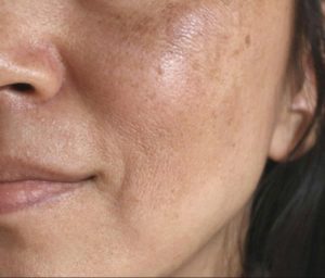 Lan da deu mau mo dom nam hon khi duy tri dung Huyet thanh Retinoate Program