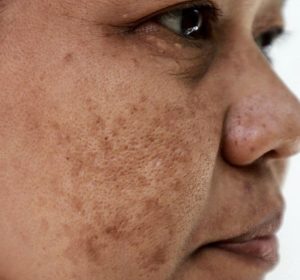 Nguoi Chau A co tong mau sam mau de bi tang sac to melanin hon so voi tong mau da sang hon