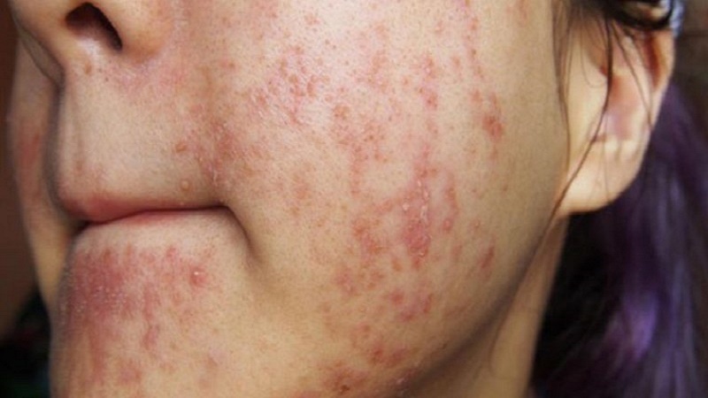 mun corticoid mun-san-mu-khi-dung-corticoid