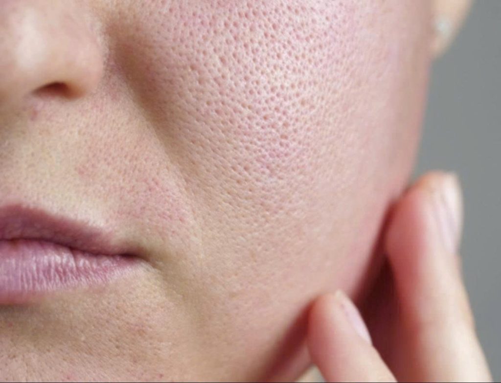 Phân biệt sự khác nhau giữa sẹo đáy nhọn và lỗ chân lông to 1 lo-chan-long-to-hay-seo-day-nhon