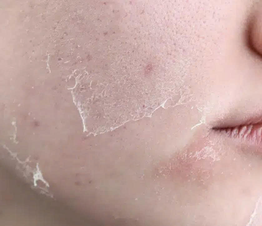 z7364122484778 18b24250ffd4d6ccf26660ce06836e60 peel-da-sau-bao-lau-thi-dep