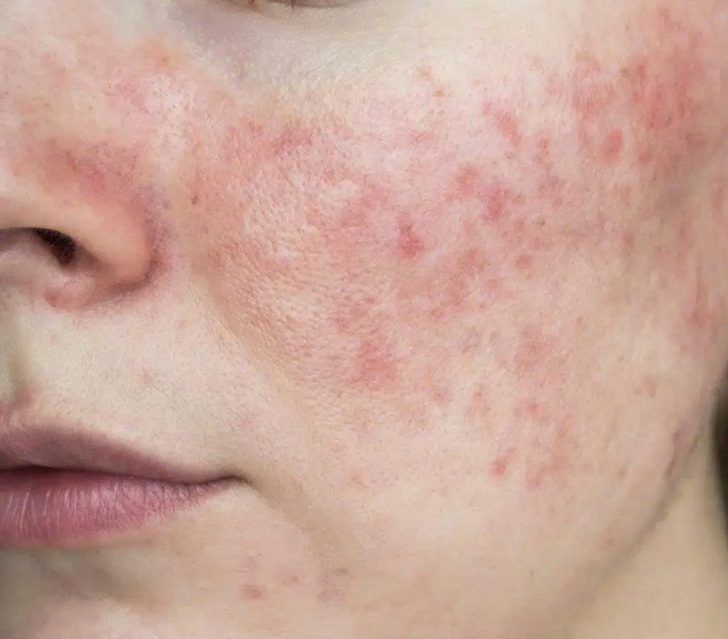 z7364122484828 8f51c6ccb759c58c920f430f61a1a850 tinh-trang-ung-do-sung-nhe-sau-peel-da