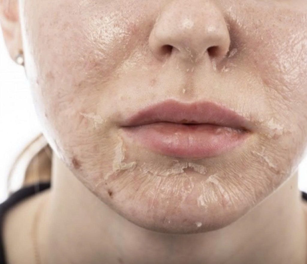 z7364123377852 cd824391216549bd0d7d412d7cd8cf79 cac-mang-bong-troc-sau-peel-da