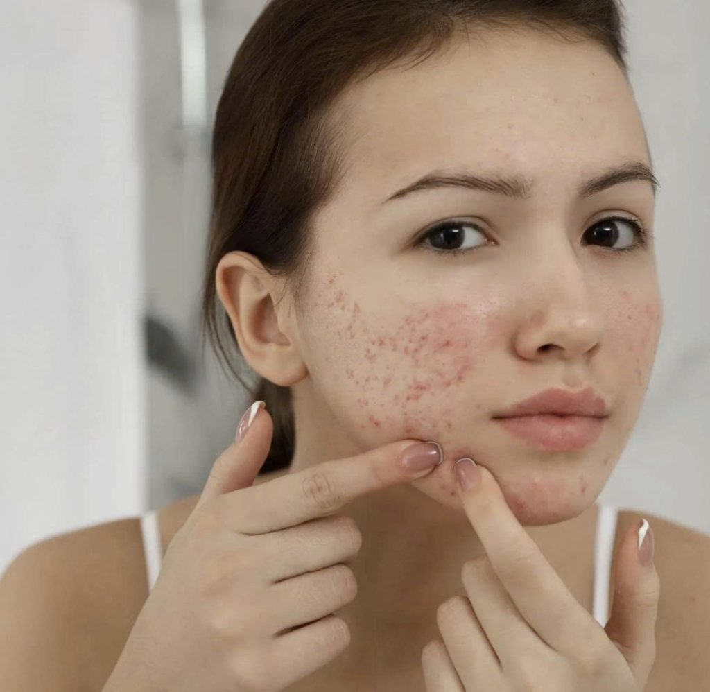 z7367267754224 63038d4e4bf0c3a802da66011aafe866 peel-da-tri-tham-sau-mun