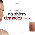 cach-nhan-biet-da-nhiem-demodex-tai-nha