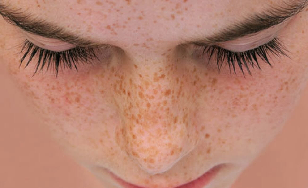 Tăng sắc tố da roi-loan-sac-to-va-su-hinh-thanh-cac-dom-nam