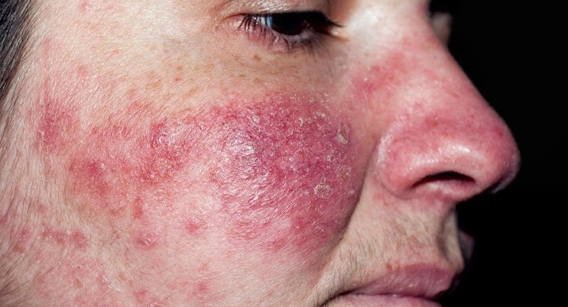 xet nghiem demodex 02 xet nghiem demodex 02