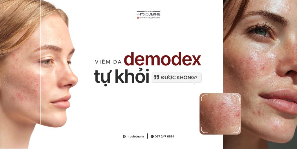 Viêm da Demodex có tự khỏi được không? 3 viem-da-demodex-co-tu-khoi-duoc-khong