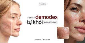 viem-da-demodex-co-tu-khoi-duoc-khong