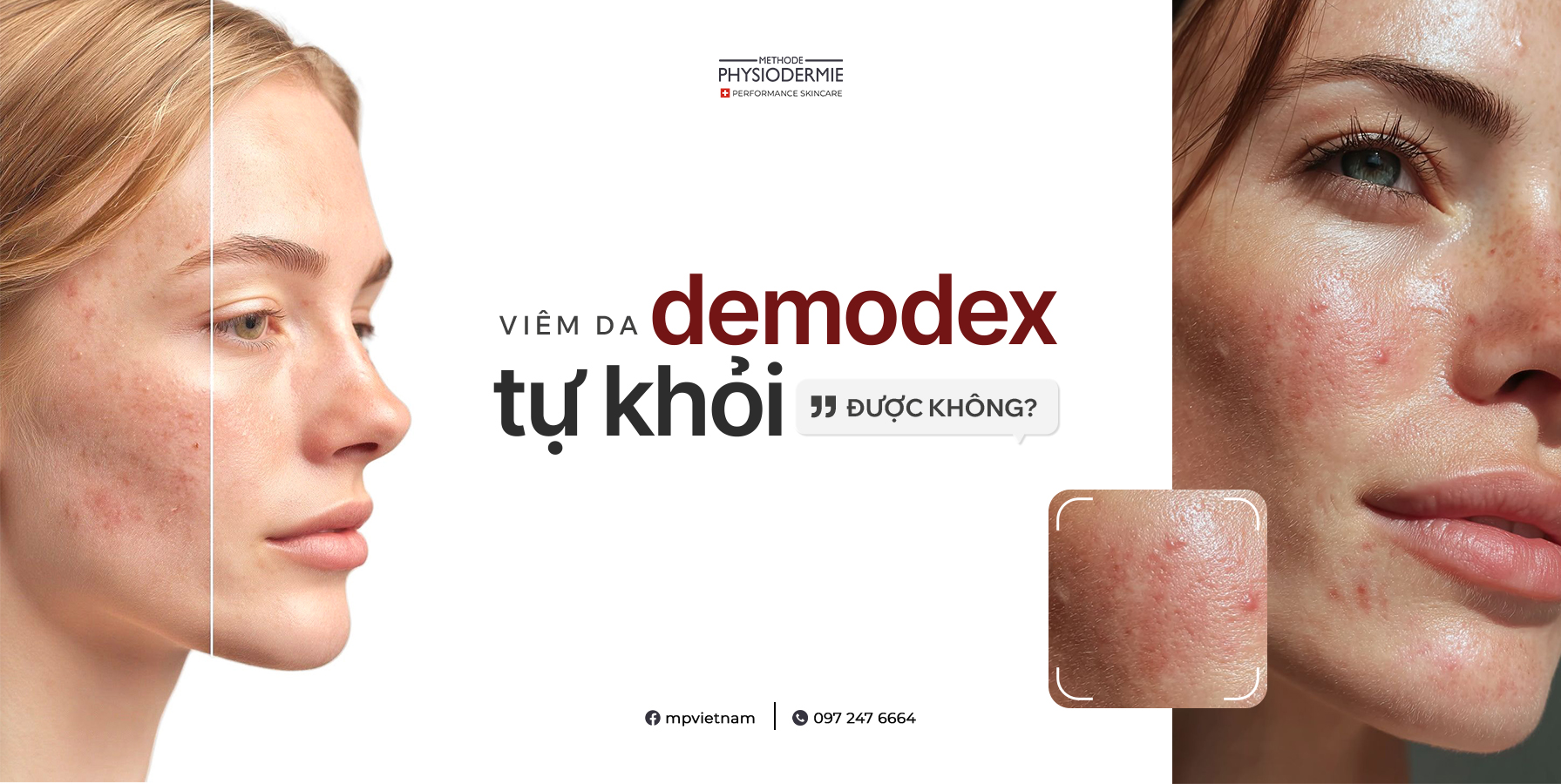 viem-da-demodex-co-tu-khoi-duoc-khong