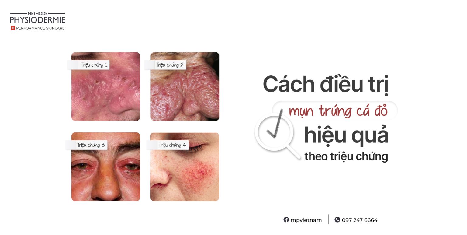 SEO Cach dieu tri benh trung ca do 2204 1536x772 phuc-hoi-da-mun-trung-ca