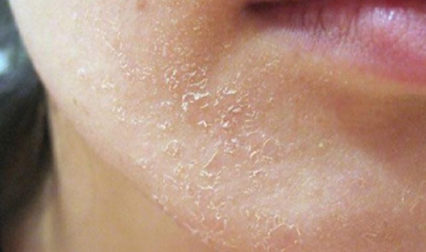 x da bong troc do kich ung retinol