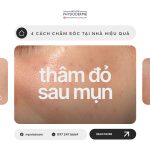 thâm đỏ sau mụn là gì và cách chăm sóc