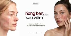 hồng ban sau viêm là gì