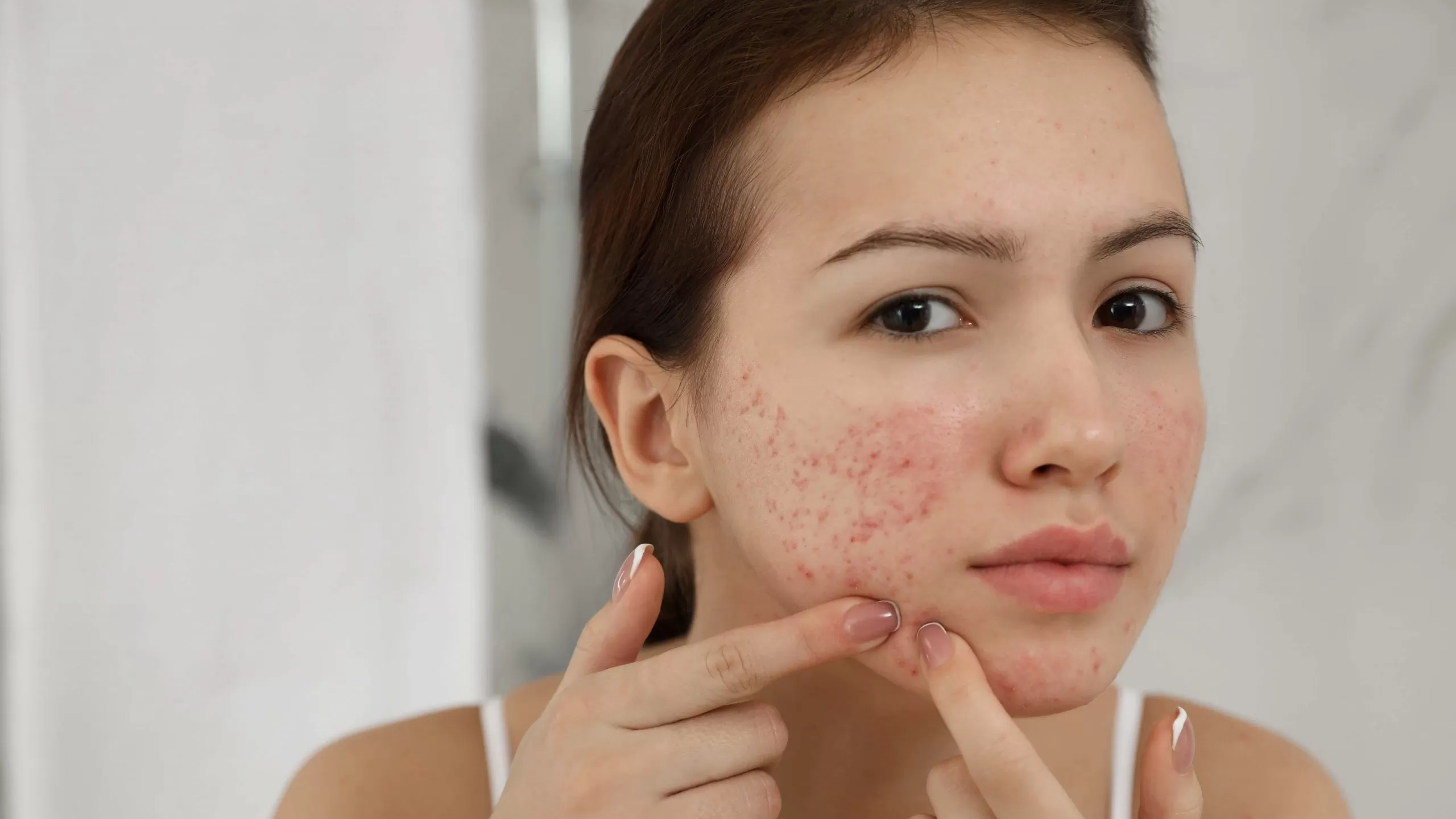 hong ban sau viem nguyen nhan va cach dieu tri hieu qua 1 7d1e46daa0 hồng ban sau viêm có tự hết không