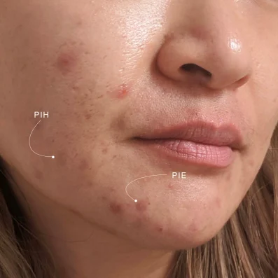 unnamed 5 c9c134dc028147a489bd0972c24697c8 phân biệt hồng ban sau viêm và tăng sắc tố sau viêm